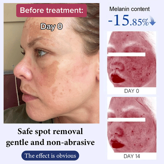 Whitening and Spot-Removing Cream💦